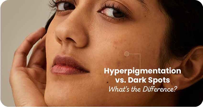 hyperpigmentation vs dark spots