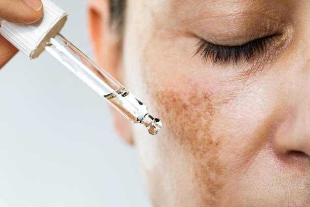 causes of dark spots on face