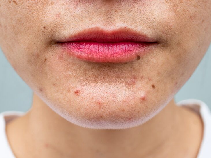 natural remedies for acne blemishes