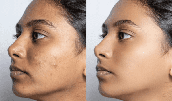 Skincare routine for dark spots